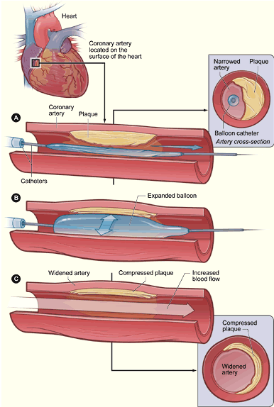 经皮冠状动脉介入治疗(图1)