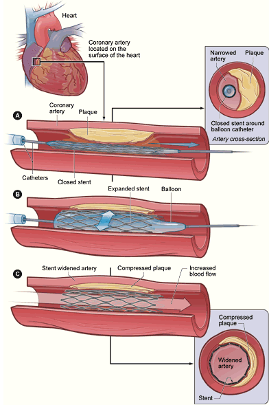 经皮冠状动脉介入治疗(图2)