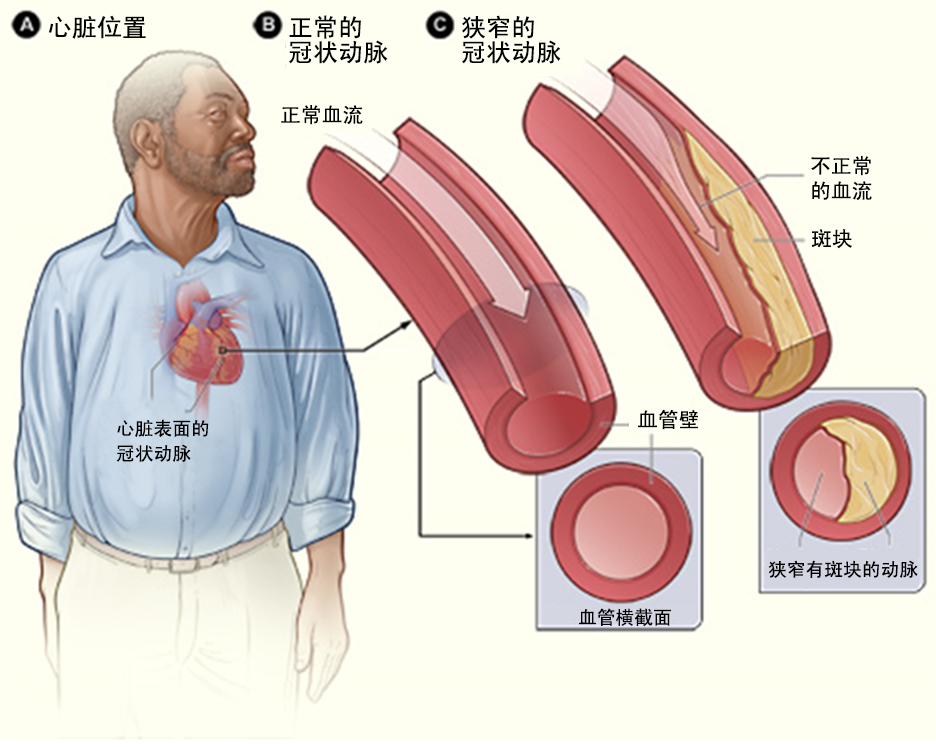 什么是冠心病?(图1)