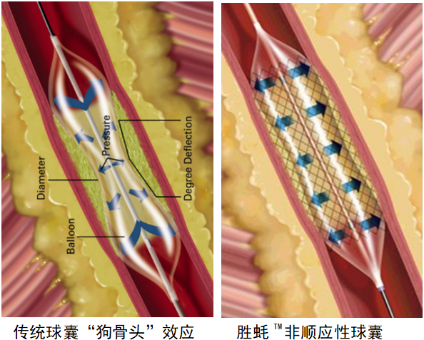 ​胜蚝™Vwin™颅内球囊扩张导管(图2)